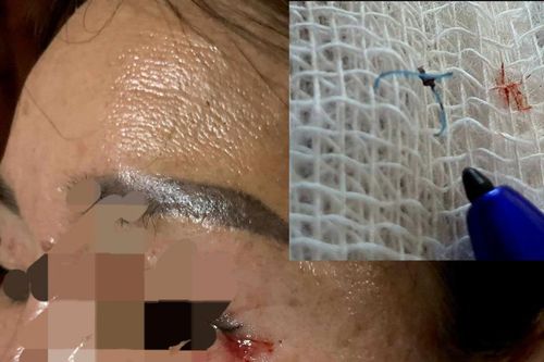 Thừa Thiên- Huế: Đi cắt mí mắt, sau 8 tháng còn sót lại chỉ khâu gần 2cm