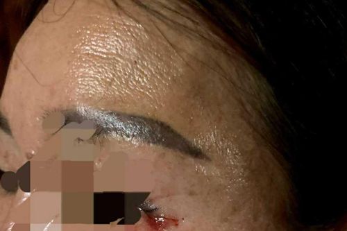 Phát hiện chỉ khâu mắt sau 8 tháng phẫu thuật thẫm mỹ