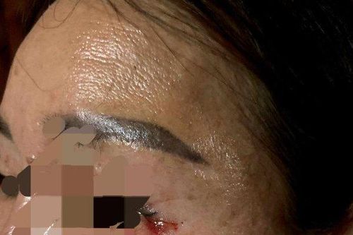 Huế: Làm rõ sự việc sau 8 tháng cắt mí mắt vẫn còn sót lại chỉ khâu
