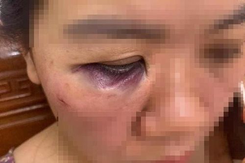 Tạm đình chỉ 2 công nhân điện lực Hà Tĩnh xô xát đến nhập viện