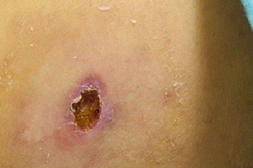 Người đàn ông nhập viện cấp cứu sau khi xuất hiện vết loét trên da