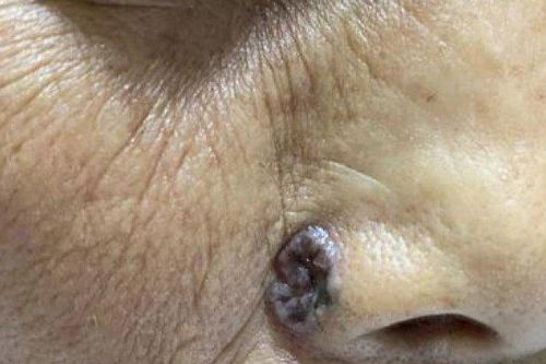 Tưởng là nốt ruồi bình thường, đi khám người phụ nữ tá hỏa khi biết mắc ung thư da hiếm gặp