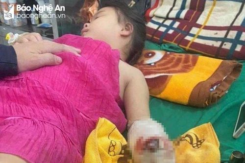 Bé gái bị máy ép nước mía cán nát bàn tay
