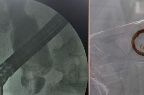 Nhiễm trùng nặng vì quên stent trong đường mật 2 năm