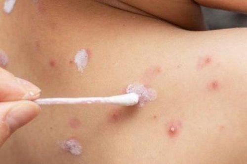 Nhiều ca thủy đậu nặng nhập viện, đã có 2 bệnh nhân tử vong
