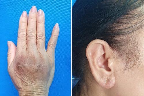 Biến chứng khó lường từ tiêm filler trôi nổi