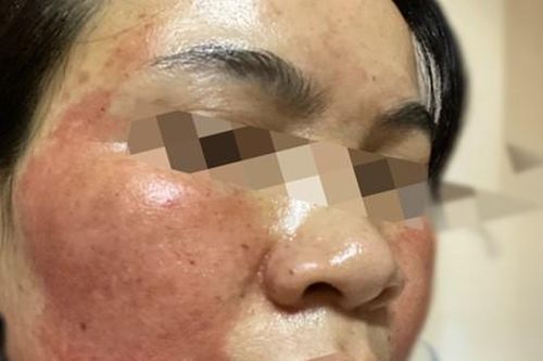 Lăn kim trị mụn, người phụ nữ nhận về khuôn mặt mưng mủ, rỉ máu