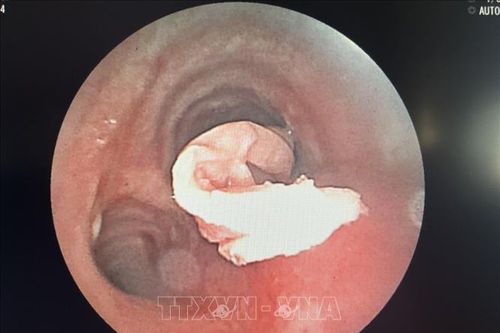 Nội soi cấp cứu lấy dị vật trong phế quản bệnh nhân ung thư