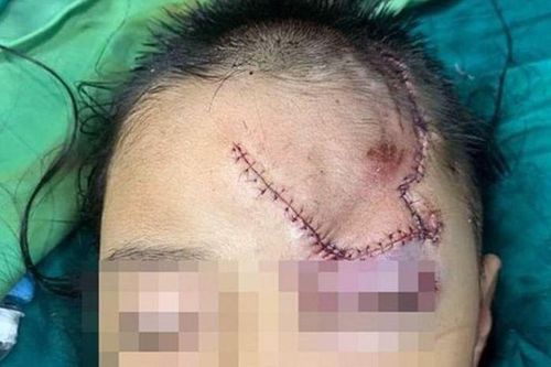 Bé trai 5 tuổi đang ngồi ở ở công nhà thì bị chó xông đến cắn xé