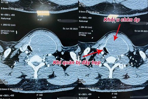 Chủ quan với u tuyến giáp lành tính, bệnh nhân bị biến chứng nặng