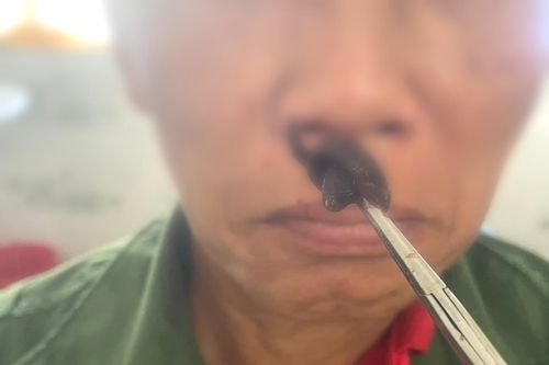 Đỉa làm tổ trong mũi người đàn ông ở Hà Giang