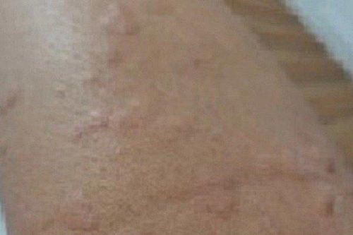 Nhập viện cấp cứu sau khi bị kiến đốt
