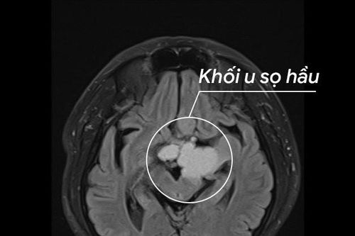 Cứu người đàn ông bị u sọ hầu hiếm gặp
