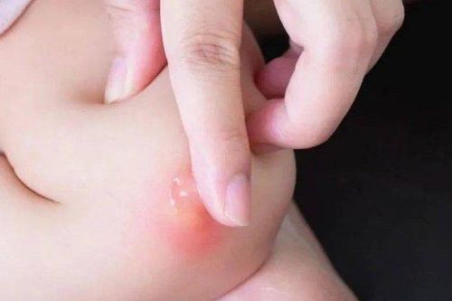 Cách giảm ngứa tức thì khi bị muỗi đốt, tiếc là đã không biết sớm hơn
