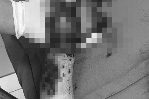 Vừa sạc vừa dùng, người phụ nữ bị điện thoại nổ nát bàn tay
