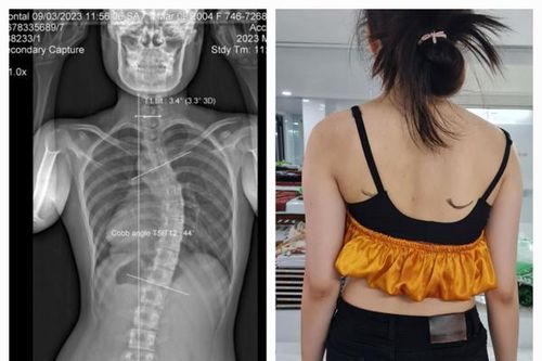 Kì tích phục hồi cong vẹo cột sống ngực 44 độ còn 37 độ của cô nàng năm 2 đại học bằng phương pháp tập luyện Yoga phục hồi tự nhiên