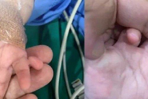 Hy hữu bé gái sinh ra khác thường với 24 ngón tay, chân