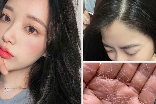 Nguyên nhân trẻ bị bạc tóc sớm