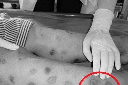Người phụ nữ xuất hiện chi chít nốt 'lạ' trên người sau khi tự tiêm canxi