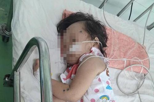 Về quê chơi lễ, mẹ và 3 con bị ong vò vẽ đốt nhập viện