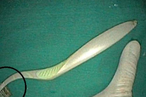 Trượt ngã khi đánh răng, cô gái nuốt bàn chải dài 20cm vào bụng