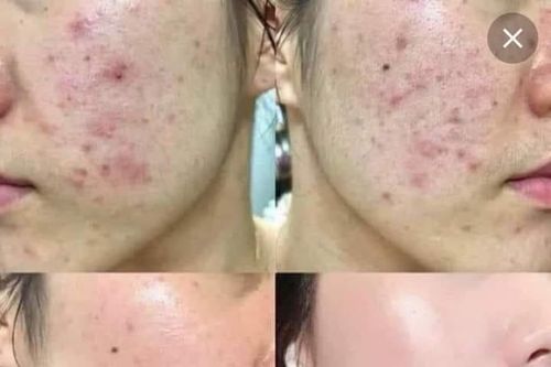 Điều trị mụn trứng cá dùng thuốc gì nhanh khỏi?