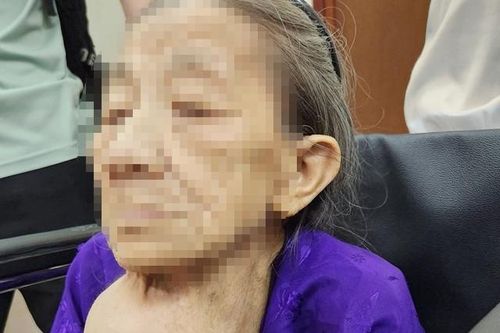 Cắt bỏ bướu giáp khổng lồ đeo bám 40 năm cho cụ bà 92 tuổi