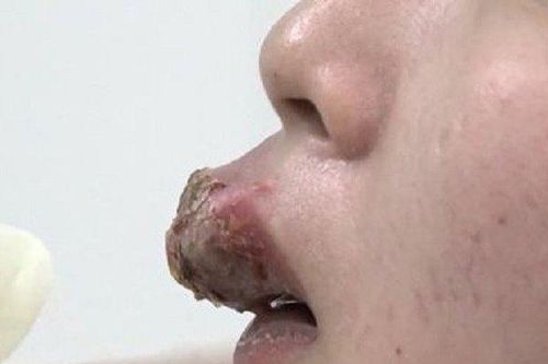 Mất tiền xăm môi, người phụ nữ nhận cái kết môi sưng như 'xúc xích'