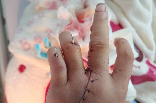 Ghép nối lại bàn tay cho nam bệnh nhân bị đứt lìa 2 ngón