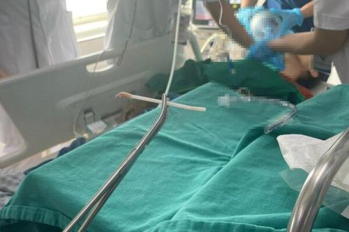 Tăm bông mắc tại khí quản, người phụ nữ liên tục khó thở