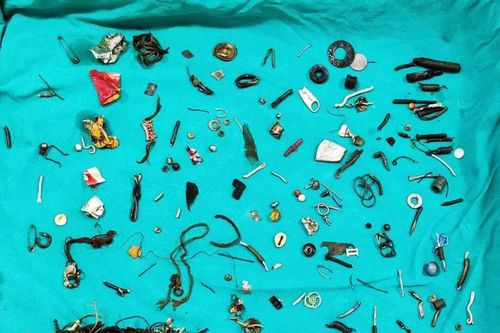 Bác sỹ sốc khi phát hiện cả 'nhà kho' gồm 60 món đồ trong bụng bệnh nhân