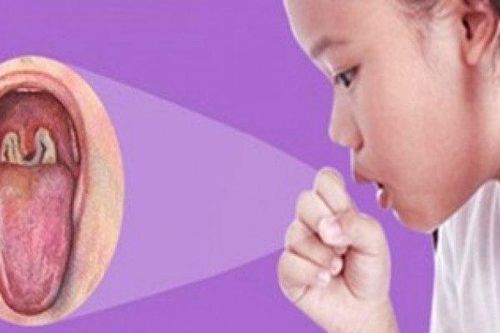 Mắc bệnh bạch hầu có thể khiến bệnh nhân tử vong trong vòng 6-10 ngày