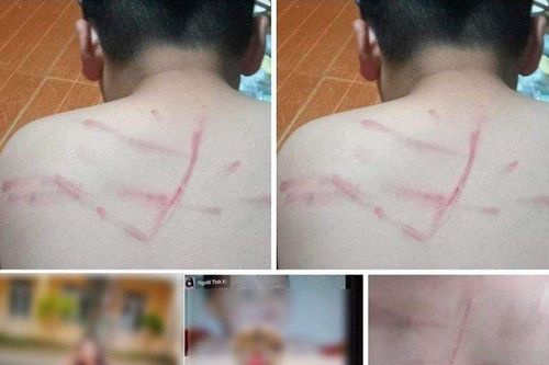 Bản tin 3/10: Học sinh lớp 4 bị cô giáo đánh 'không thương tiếc'