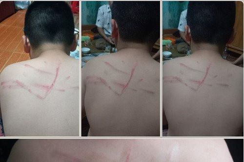 Chấm dứt hợp đồng với cô giáo đánh học sinh lớp 4 bị bầm tím lưng