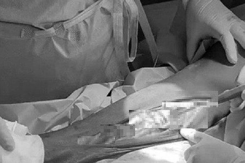 Người đàn ông suýt bị cắt cụt hai chân vì thói quen nguy hiểm này