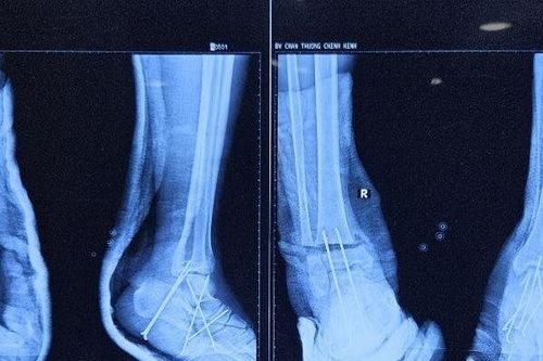 Hy hữu bệnh nhân bị đứt lìa cổ chân được phẫu thuật kịp thời