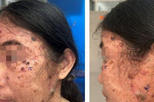 Người phụ nữ có gần 20 tổn thương ung thư da ở mặt, cổ