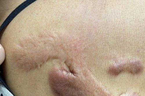 Người phụ nữ gánh tật vì 'cú lừa' của spa