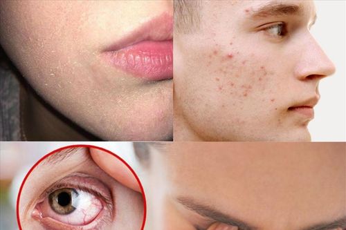 Dấu hiệu làn da thiếu vitamin và cách bổ sung