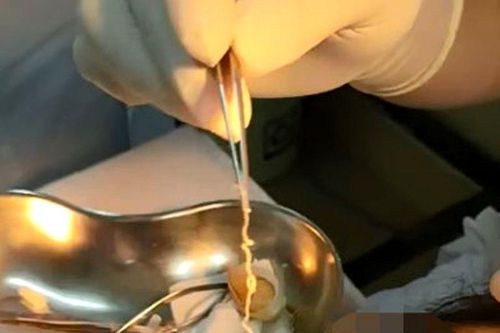 Giun dài 10cm sống trong mắt người phụ nữ