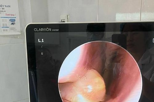 Bé 4 tuổi mọc răng trong khoang mũi, các bác sĩ phải gấp rút làm điều này