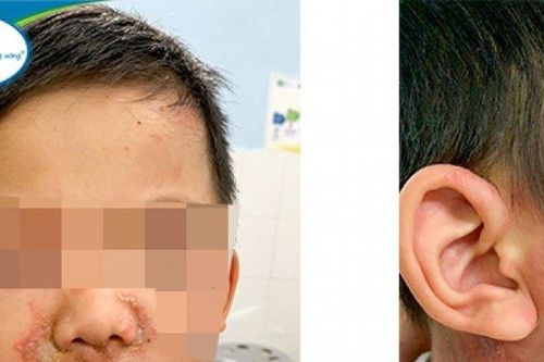 Độc tố kiến ba khoang mạnh gấp 12-15 lần rắn hổ mang, bác sĩ hướng dẫn cách xử trí