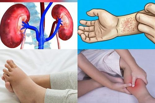 6 thói quen tàn phá thận nhiều người Việt đang mắc, đêm ngủ nếu có 4 dấu hiệu này cần được khám sớm!