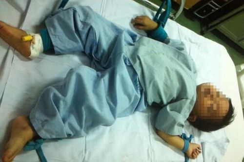 Bé 2 tuổi nuốt đinh sắt: Các cách xử lý dị vật