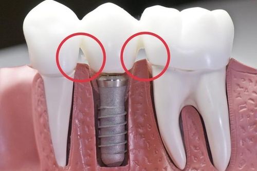 Cảnh báo tình trạng giắt răng sau cấy ghép implant