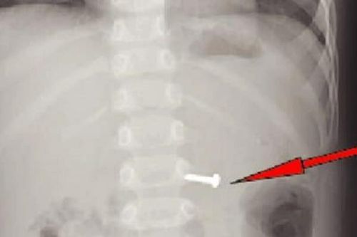 Mải chơi không để ý, cháu bé 19 tháng tuổi nuốt ốc vít 1,5cm