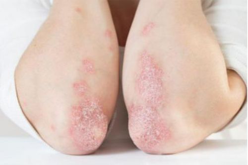 Gia tăng các bệnh lý về da liên quan đến miễn dịch