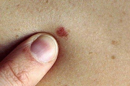 Thấy vết đen 'lạ' ở chân, nam thanh niên đến thẩm mỹ đốt đi ai ngờ mắc bệnh nặng hơn
