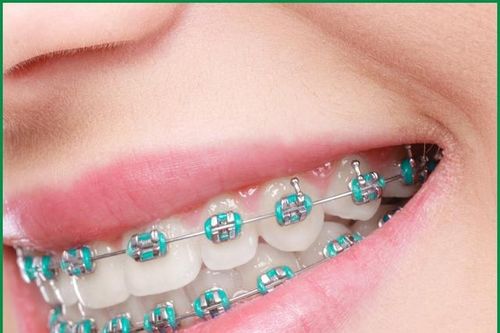 Nên chọn niềng răng mắc cài kim loại hay sứ?