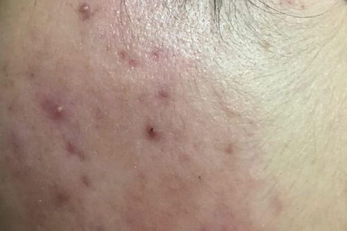Chăm sóc da như thế nào để ngăn ngừa mụn trứng cá ở tuổi dậy thì?